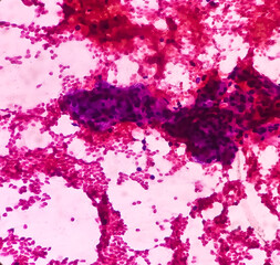 Fine needle aspiration (FNA) cytology of chronic sialadenitis of neck, show cellular material composed of salivary acini, lymphocytes and histiocytes on background of blood.