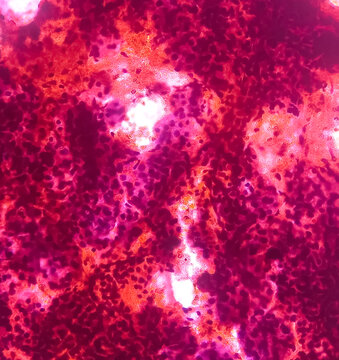 Fine needle aspiration (FNA) cytology of chronic sialadenitis of neck, show cellular material composed of salivary acini, lymphocytes and histiocytes on background of blood.