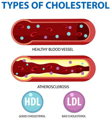 Types of Cholesterol HDL and LDL