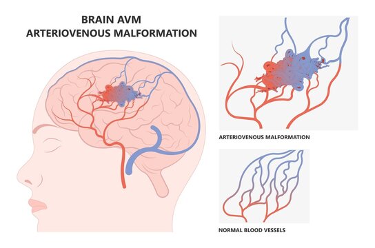 Scalp Brain Ct Scan X-ray Image Mri Diagnose Blood AVM Artery Veins Flow Stroke Loss Of Optic Nerve Pain Head Galen Swelling Tangle Capillaries System Nidus Cerebral Attack Transient Dural Fistula