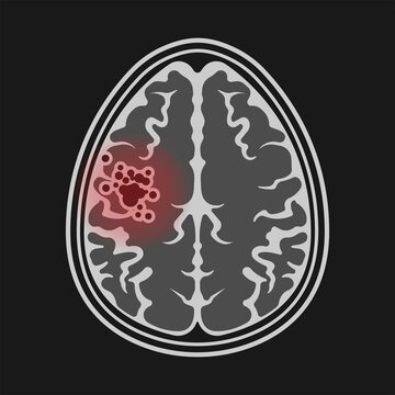 ct scan X-ray image mri diagnose capillaries system stroke scalp brain Blood AVM artery veins flow Loss of optic nerve pain head galen swelling tangle nidus cerebral attack Transient dural fistula