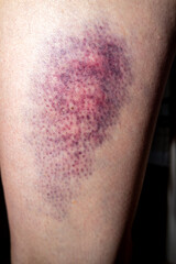 Fototapeta premium Terrible bruise on the upper leg of a woman