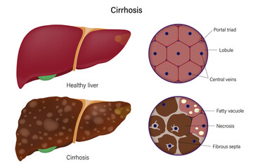 Liver histology. Normal liver and cirrhosis liver. Liver disease for medical education and science. - obrazy, fototapety, plakaty