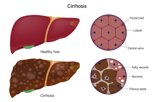 Liver histology. Normal liver and cirrhosis liver. Liver disease for medical education and science.