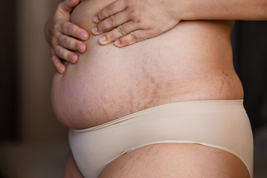 Cropped image fat overweight woman hand on tummy, with stretch marks, striae. Corpulence fat folds hanging, diastasis. Body after childbirth, fibrous collagen, dehydrated. Skin puffiness. Close up