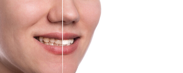 Teeth of young woman before and after whitening, dental care and whitening teeth compare, panoramic image