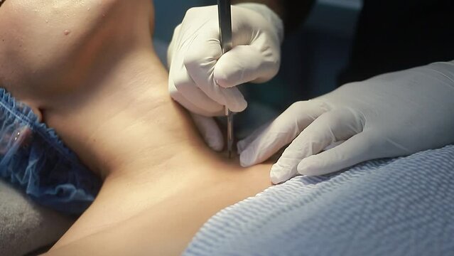 doctor with patient operating a small cyst in the operating room, closed high definition video