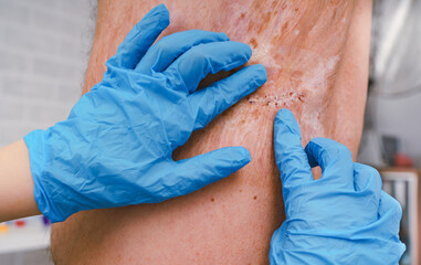 Doctor  treating  wound, burn. Emergency room hospital.The doctor examines the patient, severe burn. - 497146241