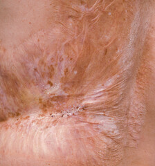 Man with a severe burn all over his body. Close up. - 497146245