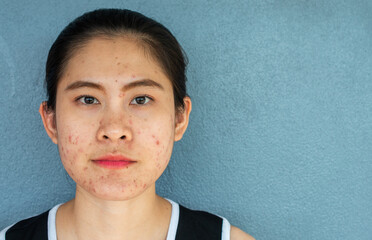 Asian woman having problems of acne inflamed on her face with copy space. Inflamed acne consists of...