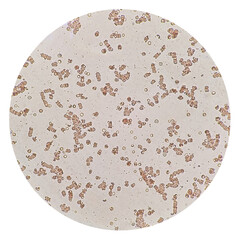 The stacks of red blood cells or Rouleaux formation in light microscope, multiple myeloma. RBC...