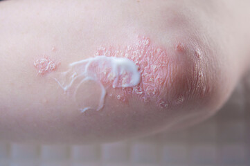 psoriasis on the skin of the elbow of a young woman in a white T-shirt. close-up