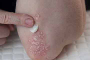 psoriasis on the skin of the elbow of a young woman in a white T-shirt. close-up