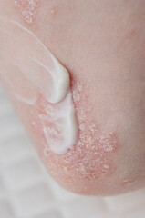 psoriasis on the skin of the elbow of a young woman in a white T-shirt. close-up