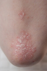 psoriasis on the skin of the elbow of a young woman in a white T-shirt. close-up