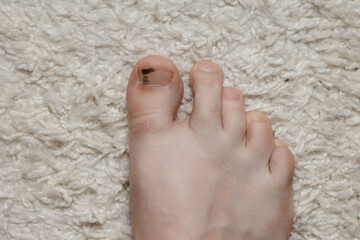 Subungual hematoma present under the toenail of the hallux, more commonly known as the big toe. Subungual hematoma is when blood forms under a fingernail or toenail, usually due to trauma.