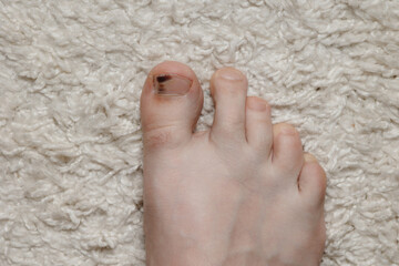 Fototapeta premium Subungual hematoma present under the toenail of the hallux, more commonly known as the big toe. Subungual hematoma is when blood forms under a fingernail or toenail, usually due to trauma.