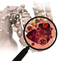 Colon cancer. Cancer attacking cell. Colon disease concept. 3d illustration