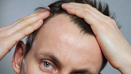 Young man with bald spots suffering from hair loss, closeup