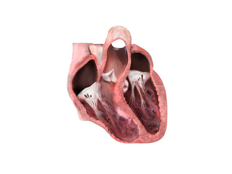 heart anatomy, Left ventricular aneurysm, wall bulge, transmural damage, aneurysm develops, dislocation, aneurysm formation, patient at risk, rupture, thrombus, embolism,