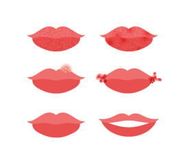 Diseases of Skin on Lips. Dry lips and Herpes. Angulus Infectiosus on Female lips. Before After. Healthy Beautiful Smile. Cartoon style. White background. Vector image for Medical and Beauty design.