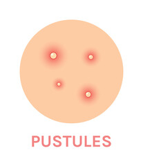 Pustules. Problem Skin with a Red Rash. Close Up view of Acne and Pimples. Color Realistic Icon. Zoom. White background. Vector illustration for Medical and Beauty design.