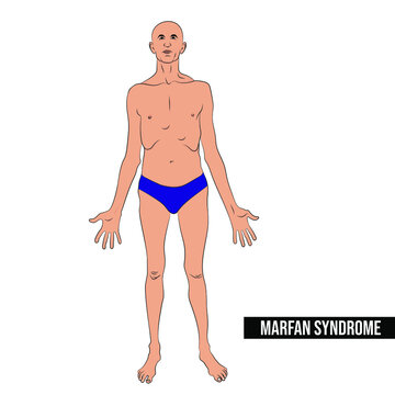 People with Marfan syndrome are tall and thin, and have long arms, legs, and fingers.