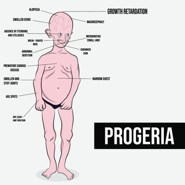 Progeria syndrome, a progressive genetic disorder that causes premature aging in children.