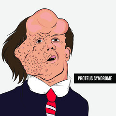 Proteus Syndrome is a congenital disease that causes excessive skin growth and abnormal development of bones, muscles, adipose tissue, blood vessels, and lymphatics. - obrazy, fototapety, plakaty