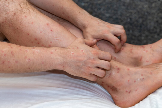 Bitten arms and legs by bloodthirsty insects in tropical countries, Scratching itchy spots, Vacation health problems with mosquitoes and sundfly