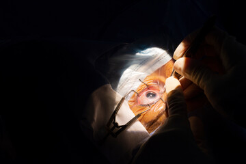 Close-up of a human eye, cataract surgery in an ophthalmology operating room.