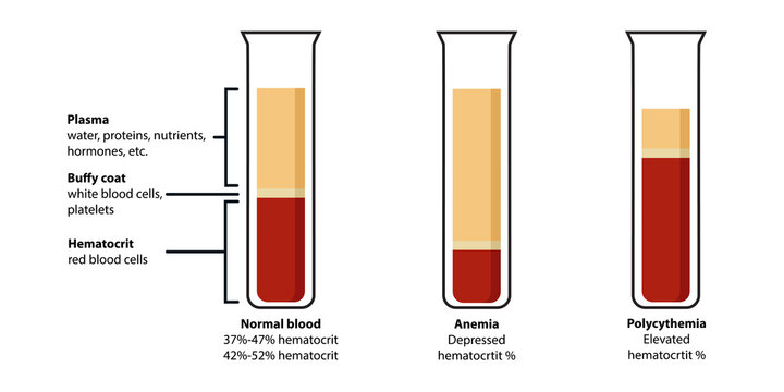 Composition of blood: plasma, buffy coat, hematocrit. Сorrelation between red blood cells (erythrocytes), white blood cells (leukocytes), proteins, hormones defines normal blood, anemia, polycythemia