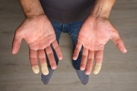 Man showing hands with Raynaud syndrome, Raynaud's phenomenon or Raynaud's disease
