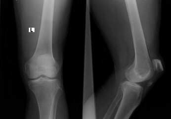 A knee xray reveals a patellar fracture. The patella is the small bone that sits in front of the knee, making it vunlnerable to fracture in vehicle collisions.