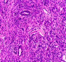 Ovarian cyst(biopsy): Mucinous cystadenoma, a benign tumor of ovary, ovarian cyst wall show fibrocollagenous tissue, single layer of columner cell with apical mucin.