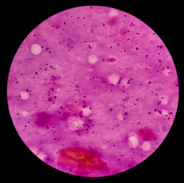 Thyroglossal cyst(FNAC): Microscopic show anucleated squames and lymphocytes.