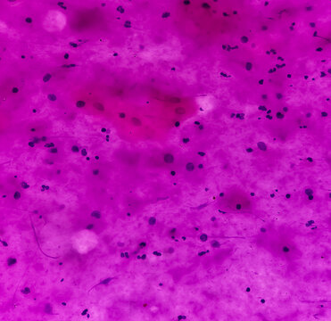 Thyroglossal cyst(FNAC): Microscopic show anucleated squames and lymphocytes.