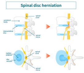 Illustration of lumbar disc herniation - obrazy, fototapety, plakaty