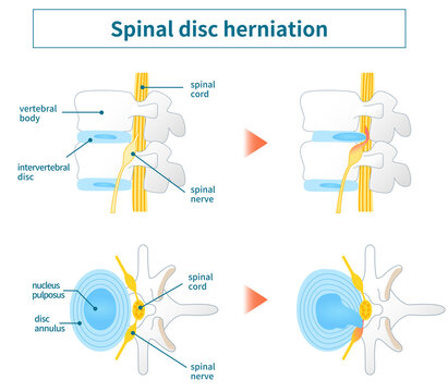 Illustration of lumbar disc herniation