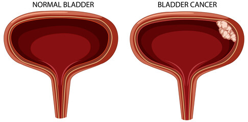Stage of bladder cancer