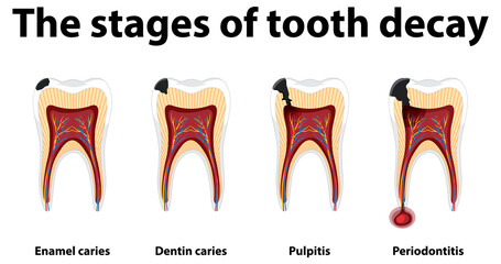 Infographic of human in the stages of tooth decay