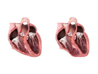 healthy heart versus aneurysm,heart anatomy, Left ventricular aneurysm, wall bulge, transmural damage, develops, dislocation, aneurysm formation, rupture, thrombus embolism 3d render