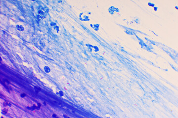 Mycobacterium tuberculosis positive (small red rod) in sputum smear, acid-fast stain, analyze by microscope 1000x