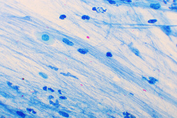Mycobacterium tuberculosis positive (small red rod) in sputum smear, acid-fast stain, analyze by...