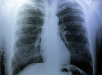 x ray image of a chest