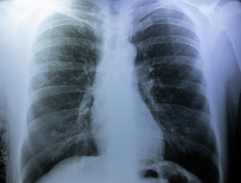 a chest x-ray of a person