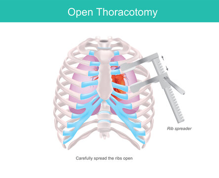 Open Thoracotomy. A procedure to gain access into the pleural space of the human chest by medical tool called Rib spreader. .