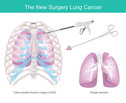 Surgical Technique For Lung Cancer. Surgical technique removing some part of the lung due to cancer. 