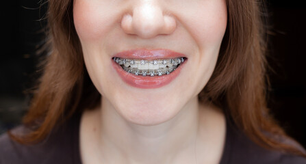 The smile of a young and beautiful girl with braces on her white teeth. Straightening of crooked teeth with the help of a bracket system. Malocclusion. Smooth teeth and a beautiful smile