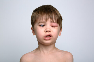 Child with red swollen eye from insect bite. Quincke edema. Portrait of unhappy boy. Isolated...